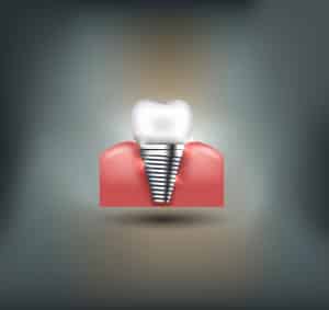 could you benefit from dental implants