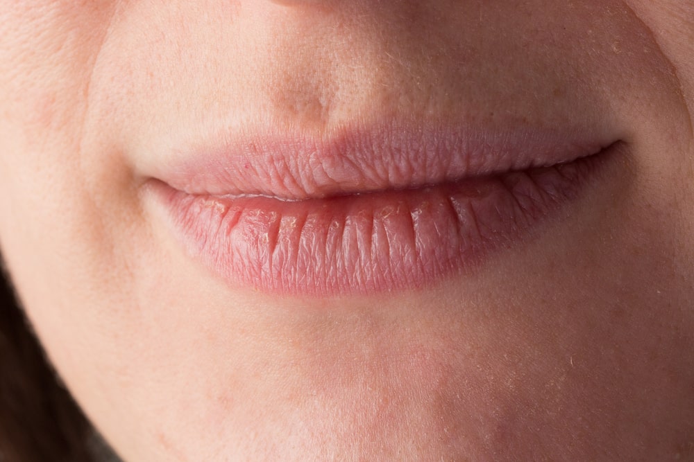 Why My Lips Are Dry And Peeling In Summer at John Taylor blog