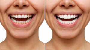 maple grove veneers